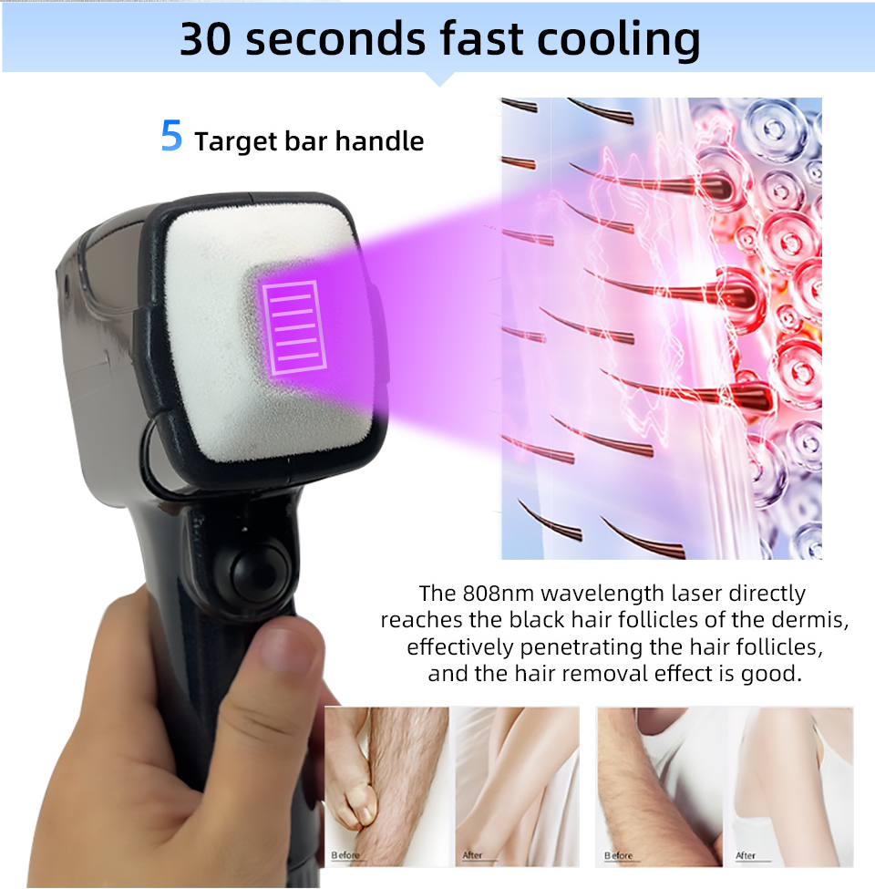 New Style Portable 808 NM Wave - Industrial Laser Hair Removal Machine review and price